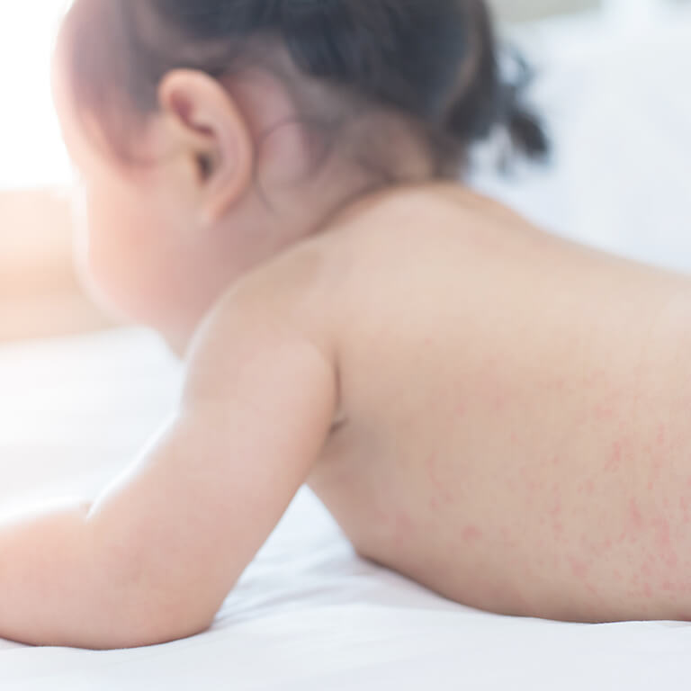 小児皮膚